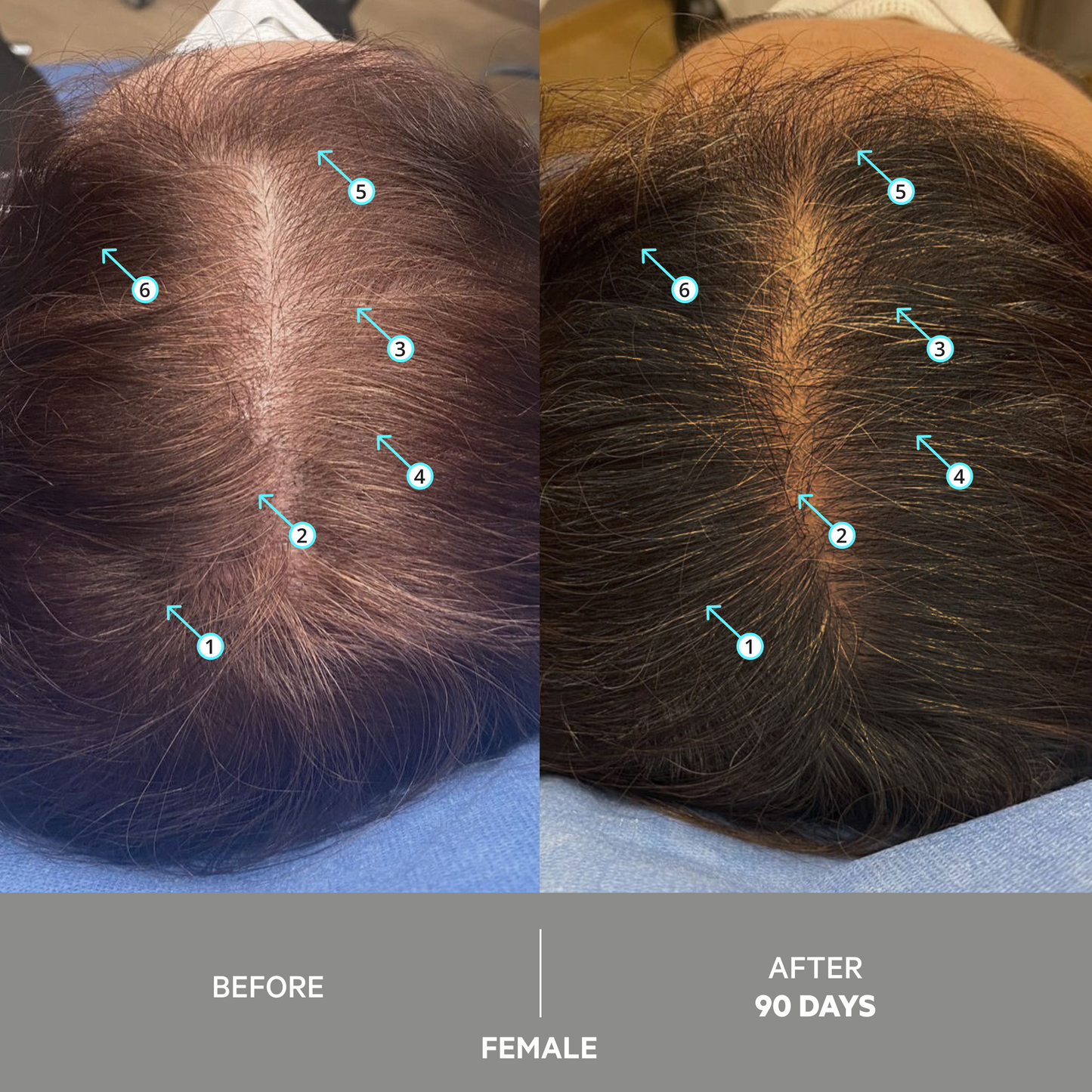 SPECTRAL EXTRA STRENGTH® | Nanoxidil 7%