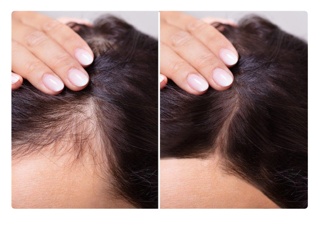 ¿Cómo lograr que vuelva a crecer cabello en las entradas?